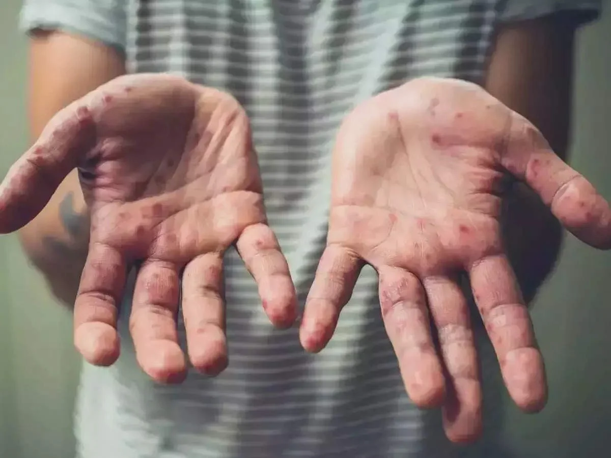 Photo of छत्तीसगढ़: रायपुर में 13 साल के बच्चे में मिला मंकीपॉक्स का लक्षण