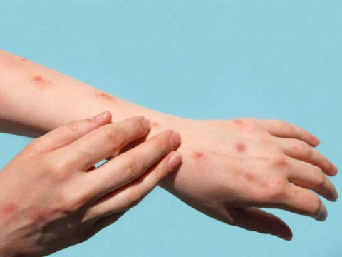 Photo of दिल्ली: मंकीपॉक्स का एक और मरीज मिला, अबतक मिले कुल 5 मामले