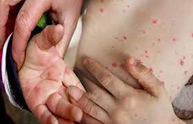 Photo of बच्चों में तेजी से फैल रही खसरा बीमारी को लेकर केंद्रीय स्‍वास्‍थ्‍य विभाग हुआ सतर्क..