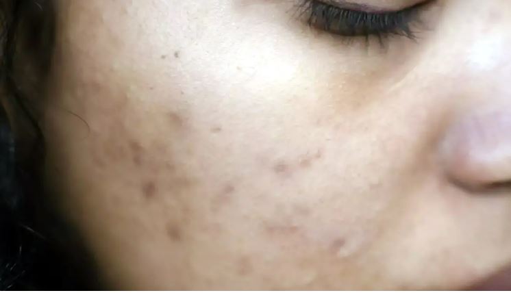 Photo of मुहासों से चेहरा हो रहा है खराब? आज ही छोड़ दें ये चीज