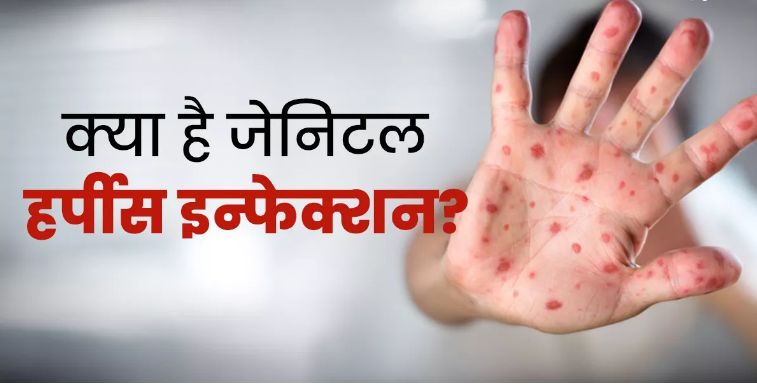 Photo of शरीर पर पानी भरे दाने हो सकते हैं जेनिटल हर्पीस के संकेत