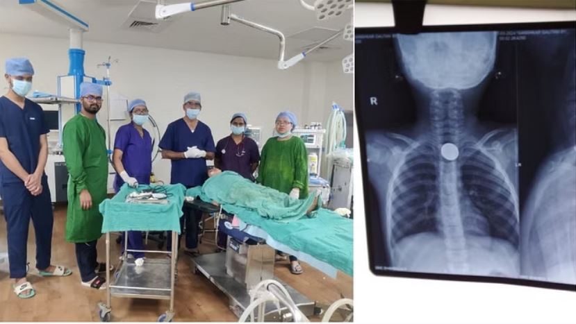 Photo of बच्चे के गले में फंसे सिक्के को जीएमसी के डॉक्टरों ने निकाला बाहर