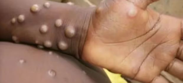 Photo of एमपाक्स की रोकथाम के लिए डब्ल्यूएचओ ने शुरू की योजना