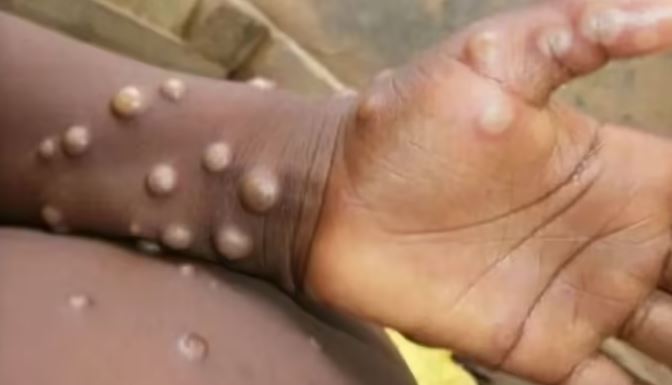 Photo of मंकीपॉक्स ने बढ़ाई डब्ल्यूएचओ की चिंता, बुलाई इमरजेंसी मीटिंग