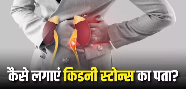 Photo of किडनी में पथरी क्यों हो जाती है और इससे आप कैसे खुद को बचा सकते हैं