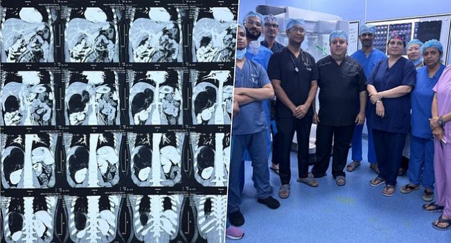 Photo of दुनिया का सबसे बड़ा ट्यूमर निकाला: फुटबॉल जितना था इसका आकार