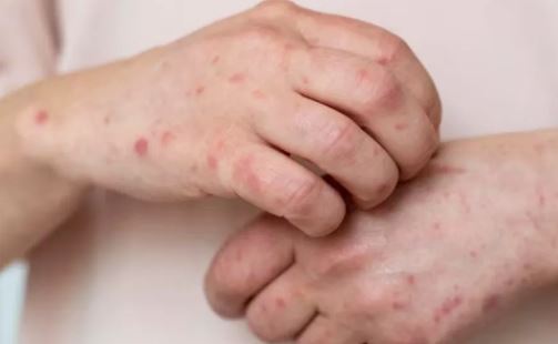 Photo of अमेरिका में Measles का प्रकोप, 483 मामले आए सामने