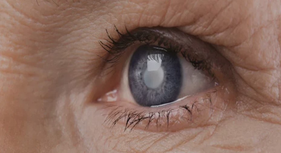 Photo of आपकी भी धुंधली हो गई है नजर, मोतियाबिंद का है शुरुआती संकेत, जानें…