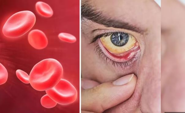 Photo of एनीमिया होने पर शरीर इन तरीकों से देता है चेतावनी…