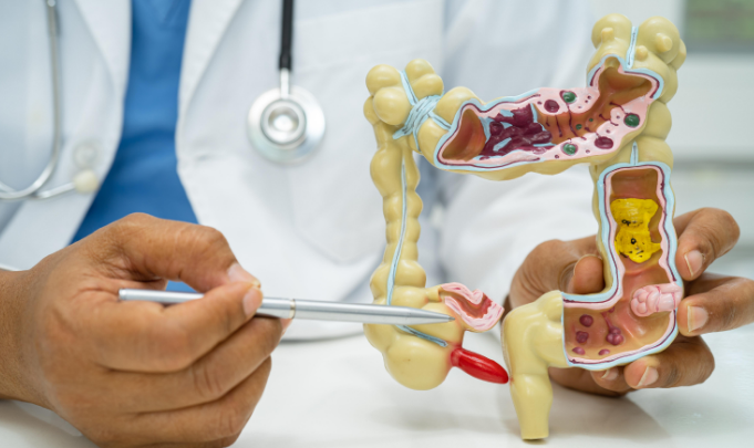 Photo of मिलेनियल्स में तेजी से बढ़ रहा है अपेंडिक्स कैंसर का खतरा