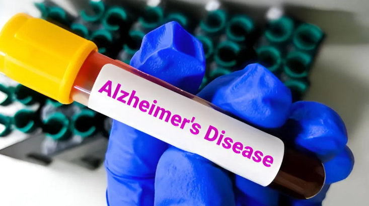 Photo of लक्षण दिखने से 10 साल पहले ही पता चल सकेगा अल्जाइमर का खतरा
