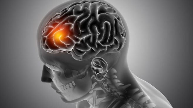 Photo of देश में तेजी से बढ़ रहीं न्यूरोलॉजिकल बीमारियां