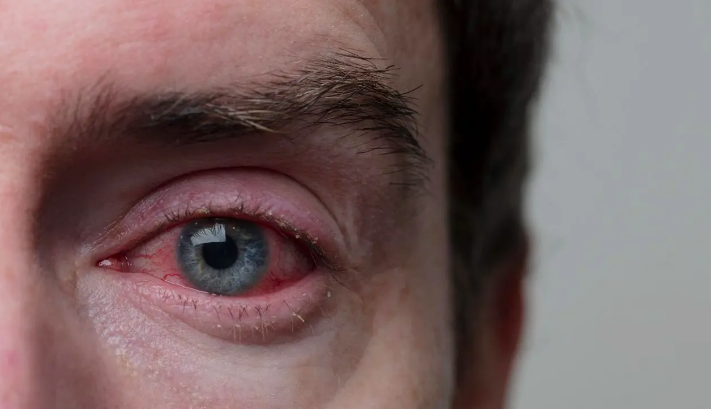 Photo of जिसे साधारण एलर्जी समझ रहे हैं, कहीं वो अर्बन आई सिंड्रोम तो नहीं?