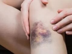 बिना चोट के शरीर पर नील पड़ना या जोड़ों में दर्द हो सकता है इस गंभीर बीमारी का संकेत