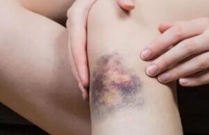 बिना चोट के शरीर पर नील पड़ना या जोड़ों में दर्द हो सकता है इस गंभीर बीमारी का संकेत