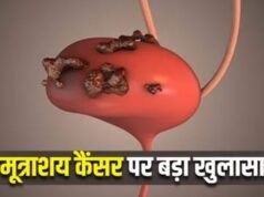 सर्जरी के बाद रेडिएशन थेरेपी से आधा हो जाता है Bladder Cancer का खतरा