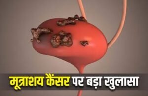 सर्जरी के बाद रेडिएशन थेरेपी से आधा हो जाता है Bladder Cancer का खतरा