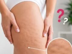 सेल्युलाइट कम करने से पहले जान लीजिए ये 5 मिथ, तभी दिखेगा असली रिजल्ट