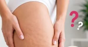 सेल्युलाइट कम करने से पहले जान लीजिए ये 5 मिथ, तभी दिखेगा असली रिजल्ट