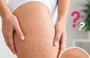 सेल्युलाइट कम करने से पहले जान लीजिए ये 5 मिथ, तभी दिखेगा असली रिजल्ट