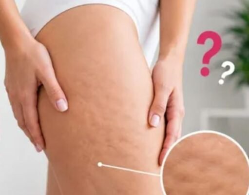 सेल्युलाइट कम करने से पहले जान लीजिए ये 5 मिथ, तभी दिखेगा असली रिजल्ट